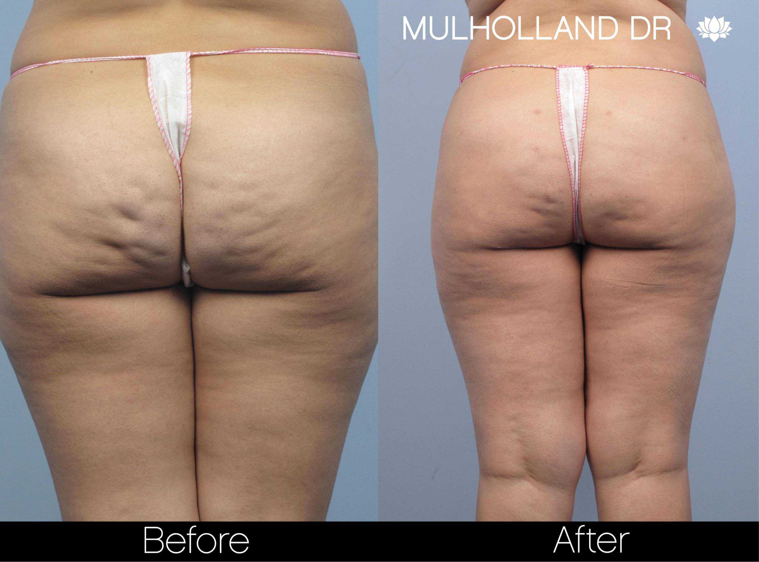 Cellulite Reduction Before and After Gallery – Photo 49