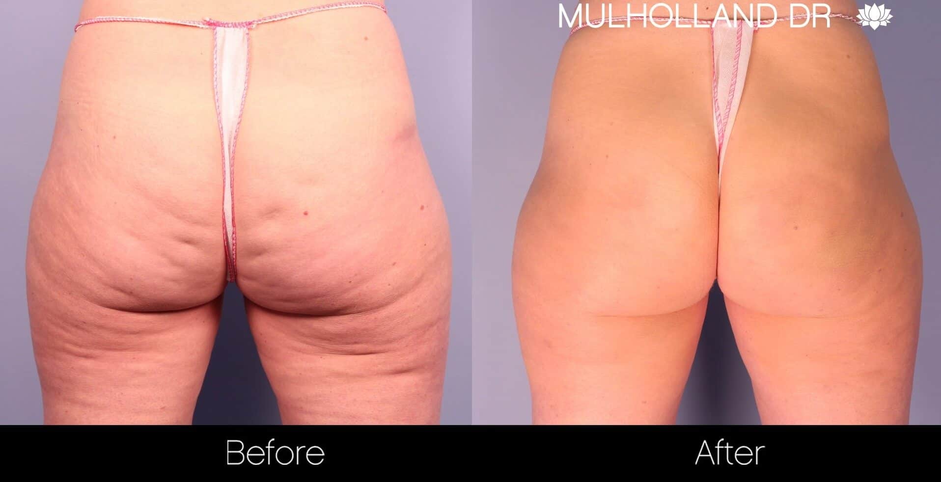Cellfina Cellulite Treatment - Before and After Gallery – Photo 1