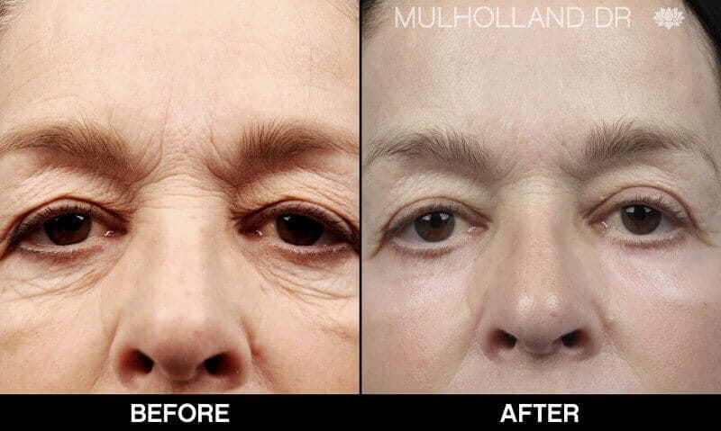 AccuTite Before and After Gallery – Photo 29