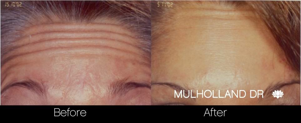 Botox Before and After Gallery - Photo 13