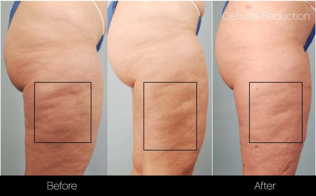 Cellulite Reduction Before and After Gallery – Photo 40