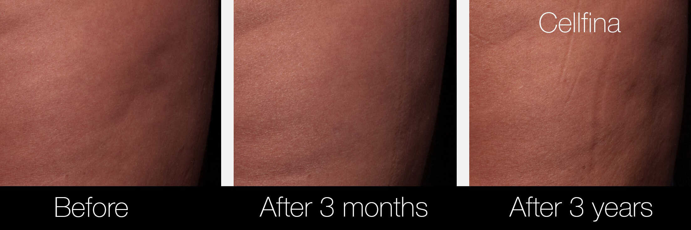 Cellfina Cellulite Treatment - Before and After Gallery – Photo 10