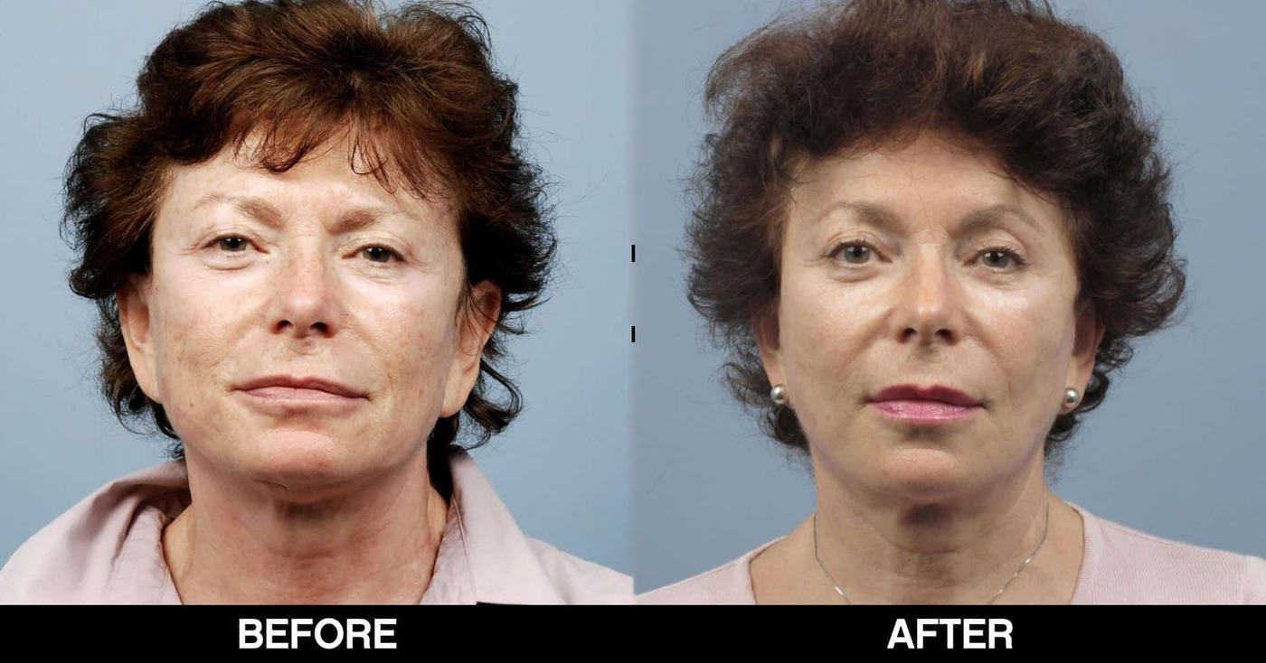 Dermal Fillers Before and After Gallery – Photo 43