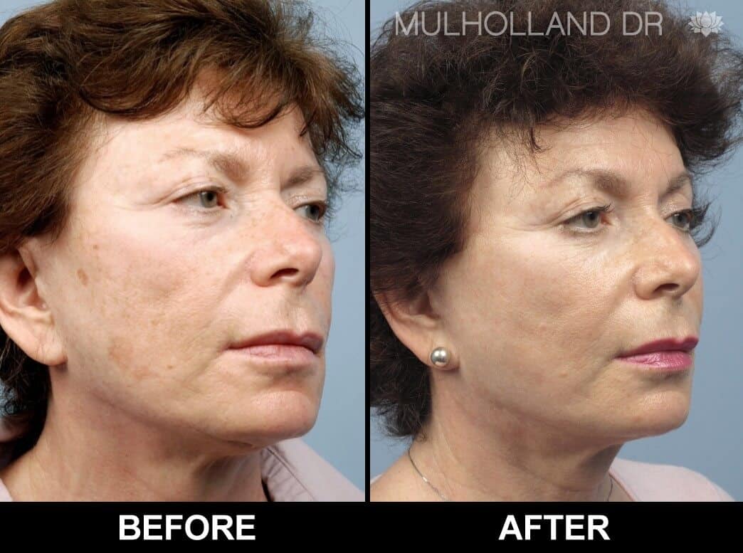 Dermal Fillers Before and After Gallery – Photo 39