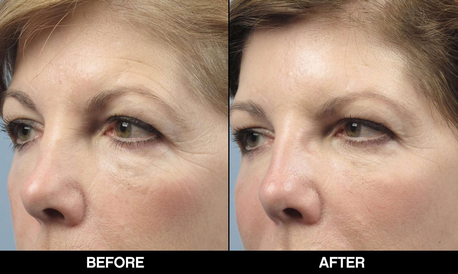 Dermal Fillers Before and After Gallery – Photo 37