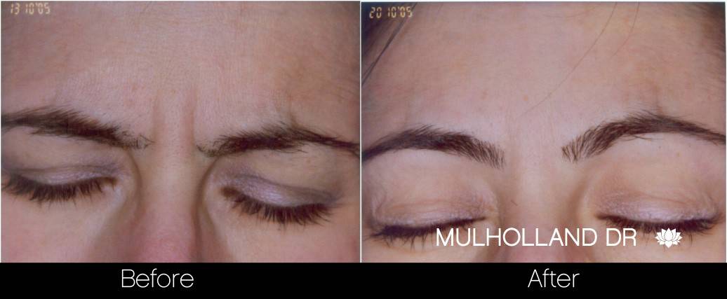 Botox Before and After Gallery - Photo 14