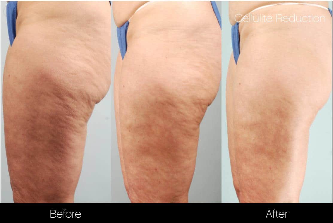 Cellulite Reduction Before and After Gallery – Photo 39