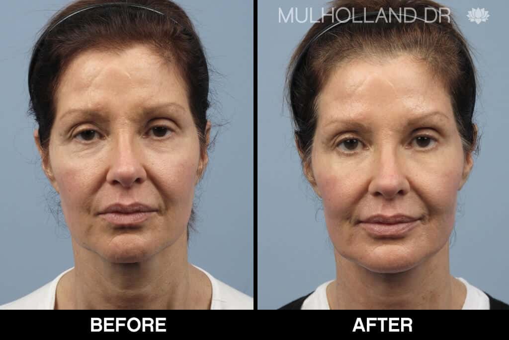 Dermal Fillers Before and After Gallery – Photo 134