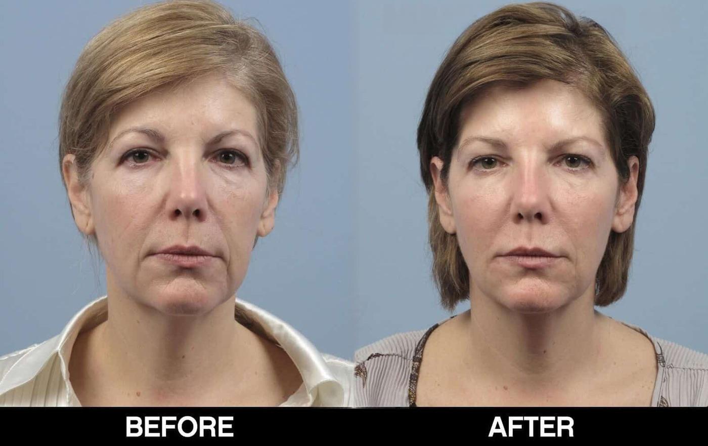 Dermal Fillers Before and After Gallery – Photo 29