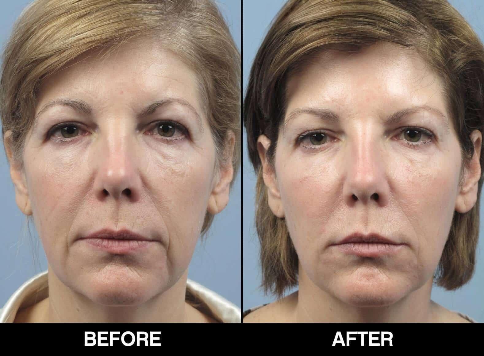 Dermal Fillers Before and After Gallery – Photo 28