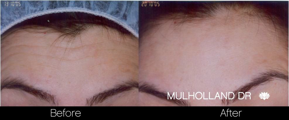Botox Before and After Gallery - Photo 15