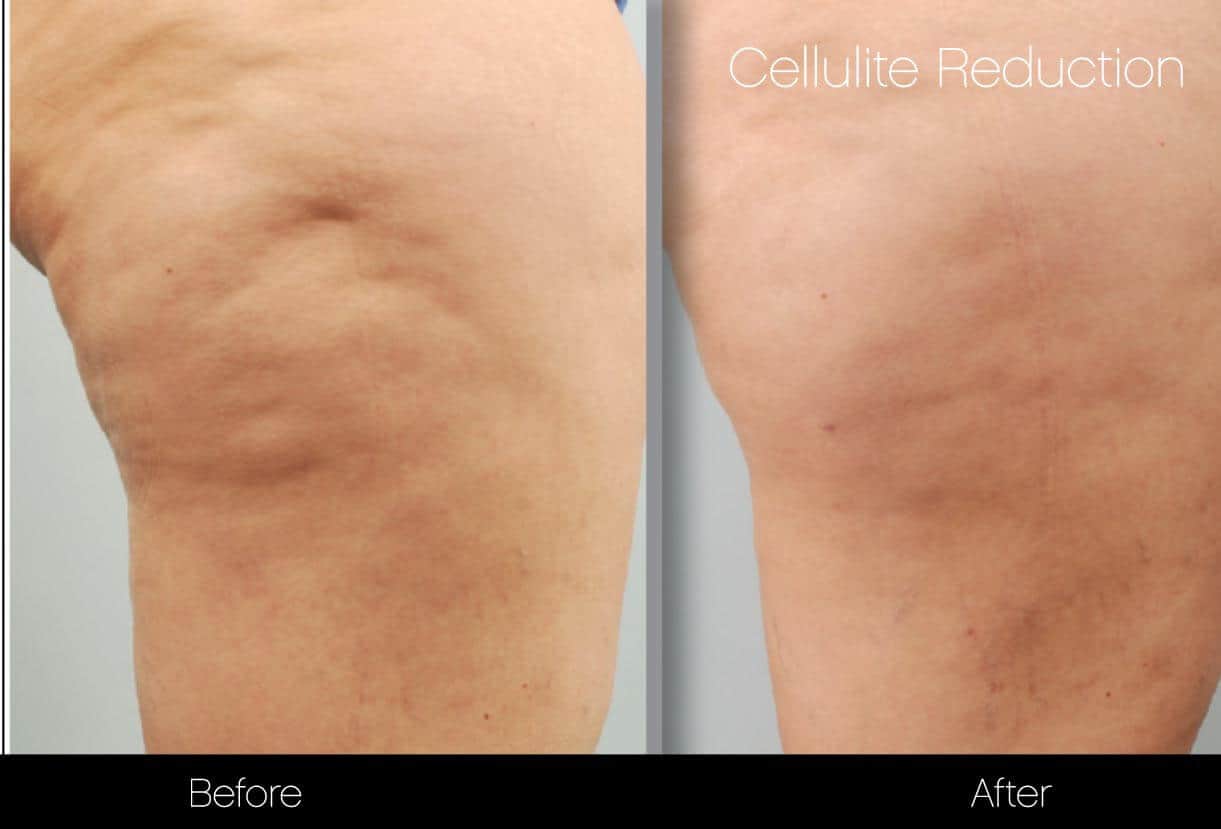 Cellulite Reduction Before and After Gallery – Photo 38