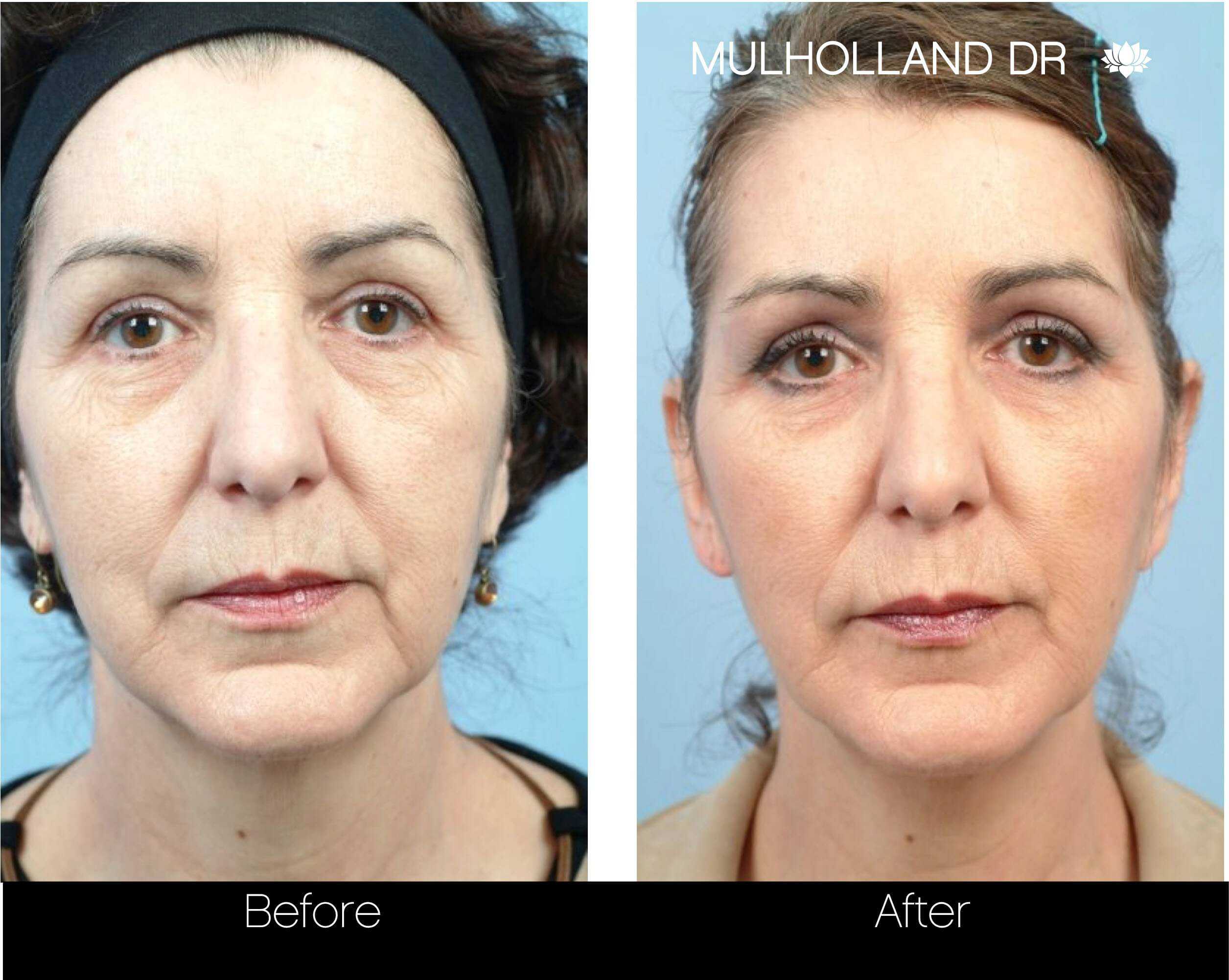 Dermal Fillers Before and After Gallery – Photo 22