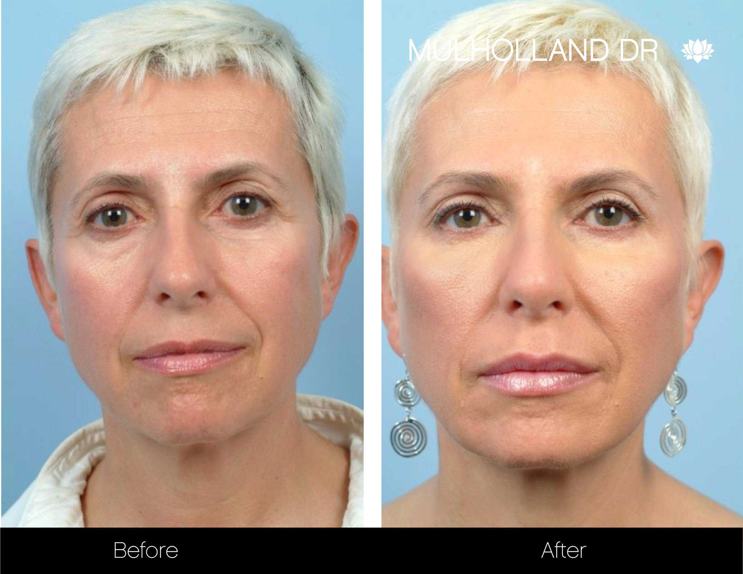 Dermal Fillers Before and After Gallery – Photo 20