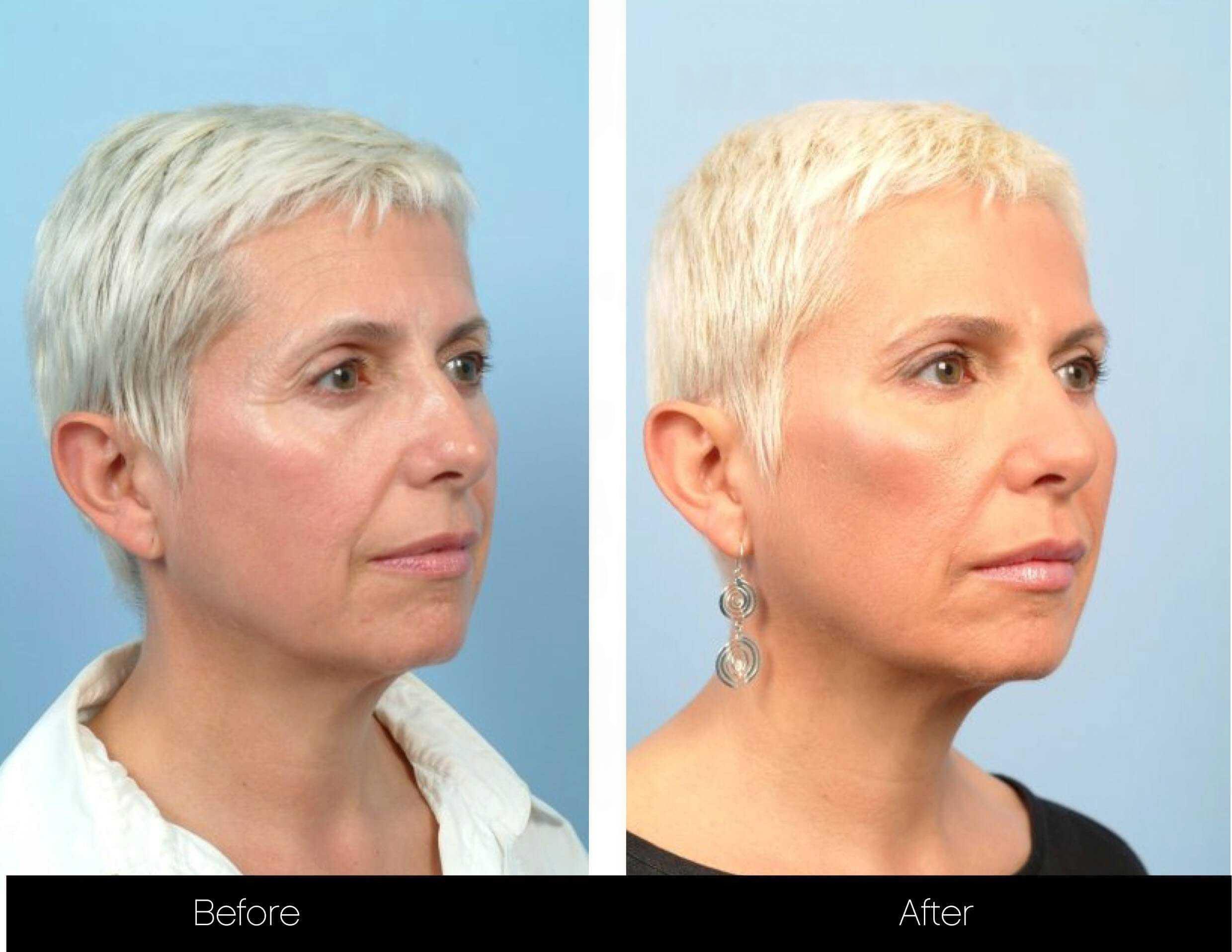 Dermal Fillers Before and After Gallery – Photo 19