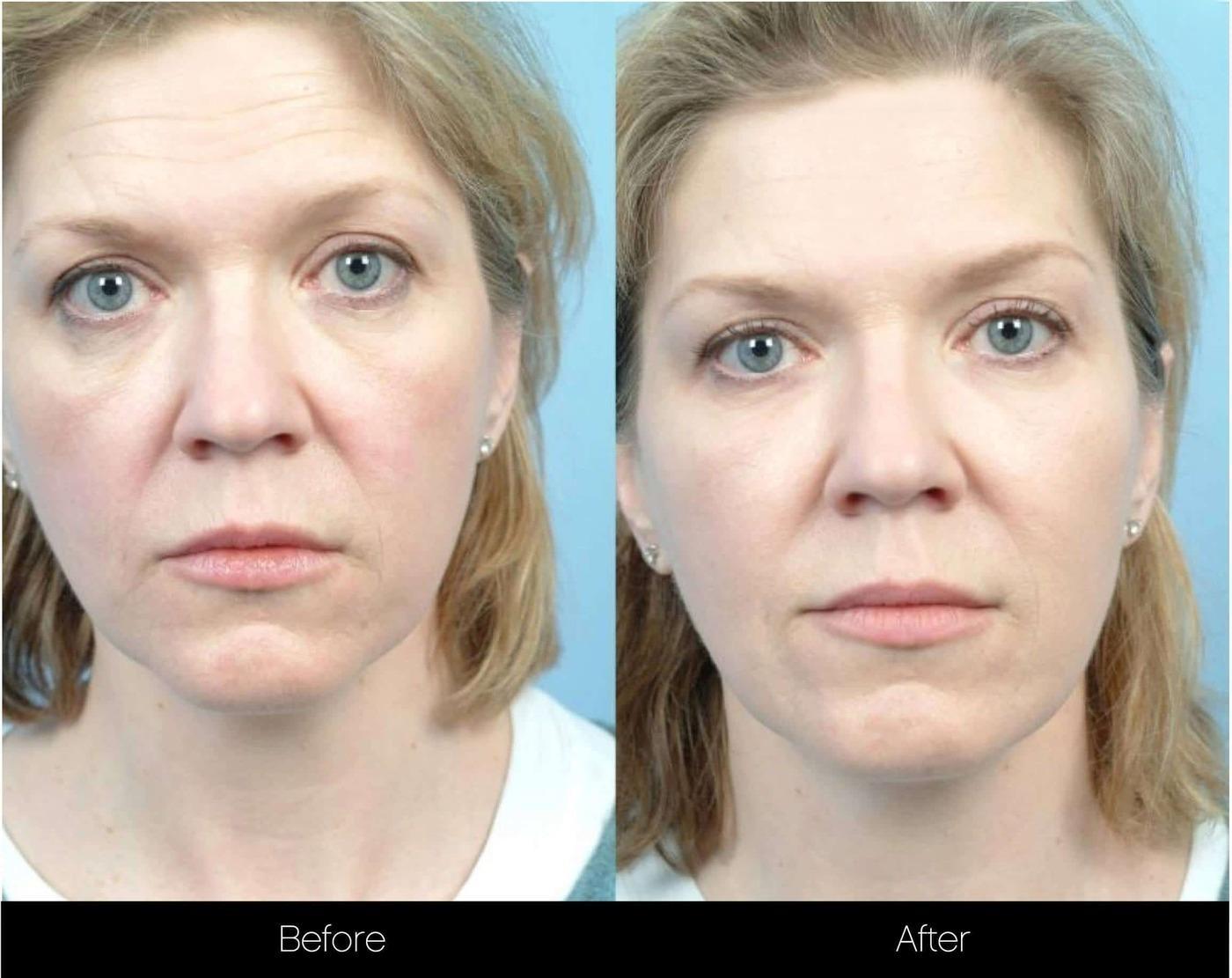 Dermal Fillers Before and After Gallery – Photo 18