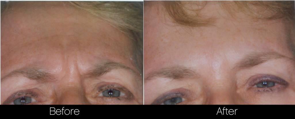 Botox Before and After Gallery - Photo 12