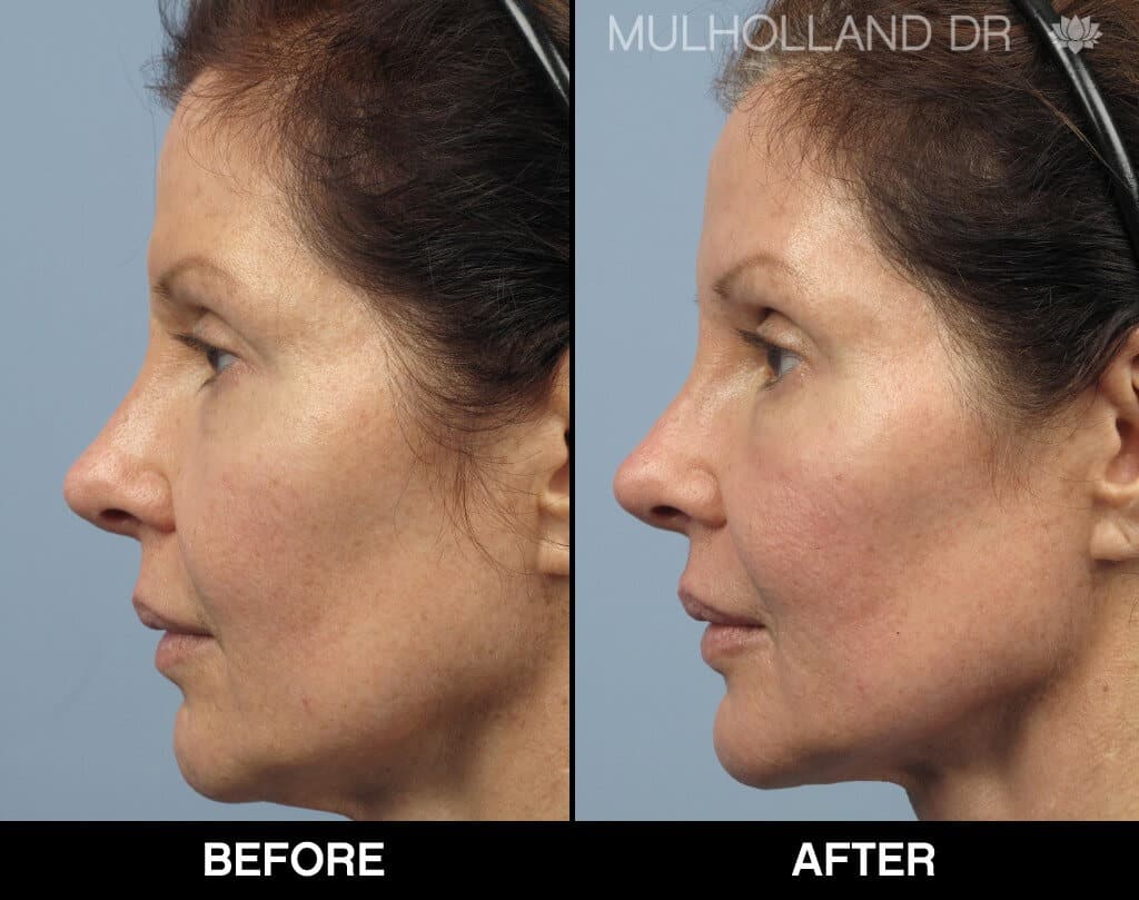 Dermal Fillers Before and After Gallery – Photo 132