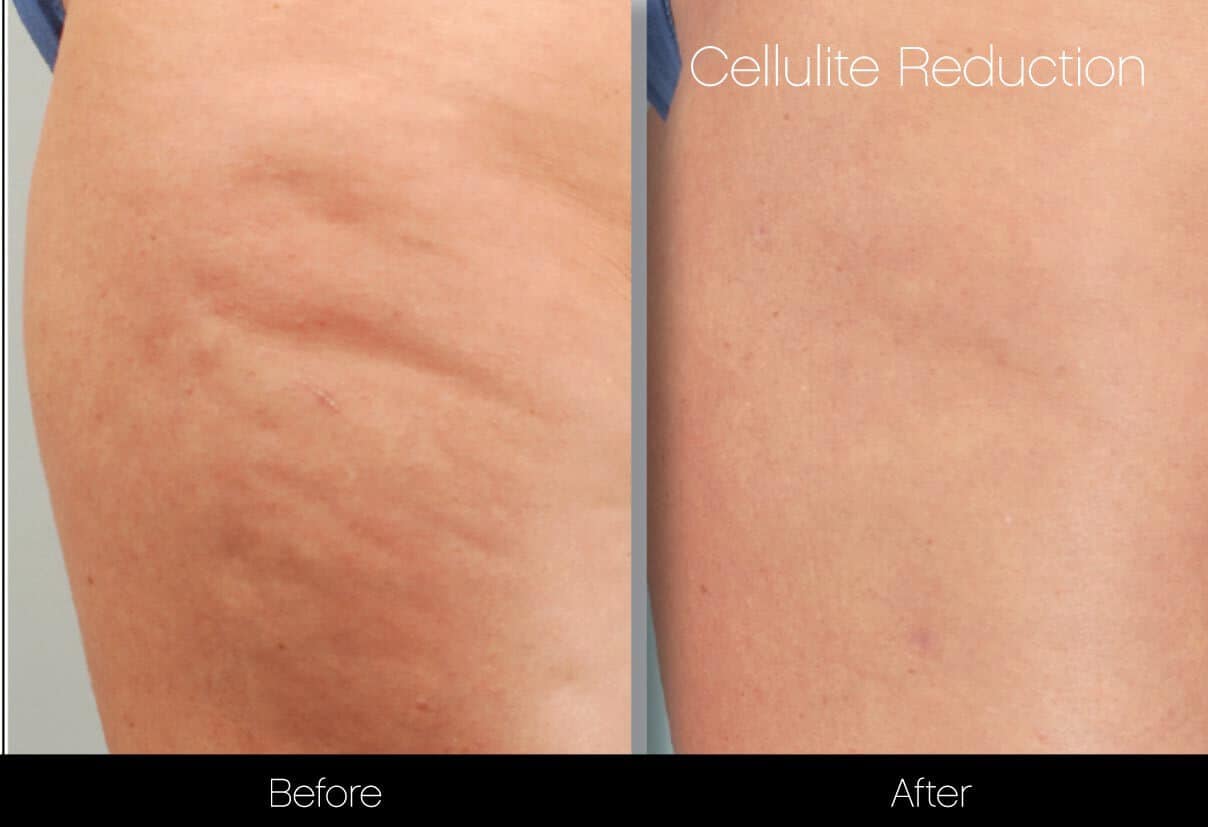 Cellulite Reduction Before and After Gallery – Photo 37