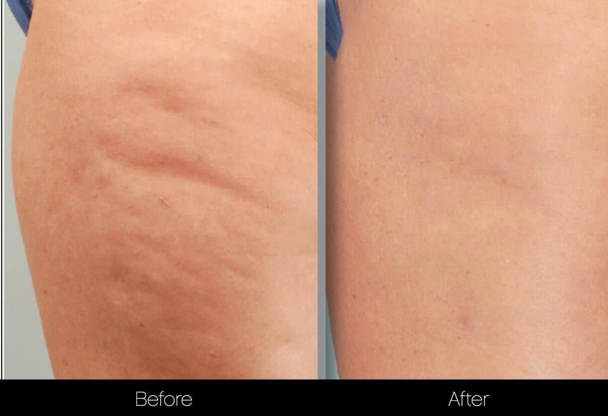 Cellulite Reduction Before and After Gallery – Photo 37