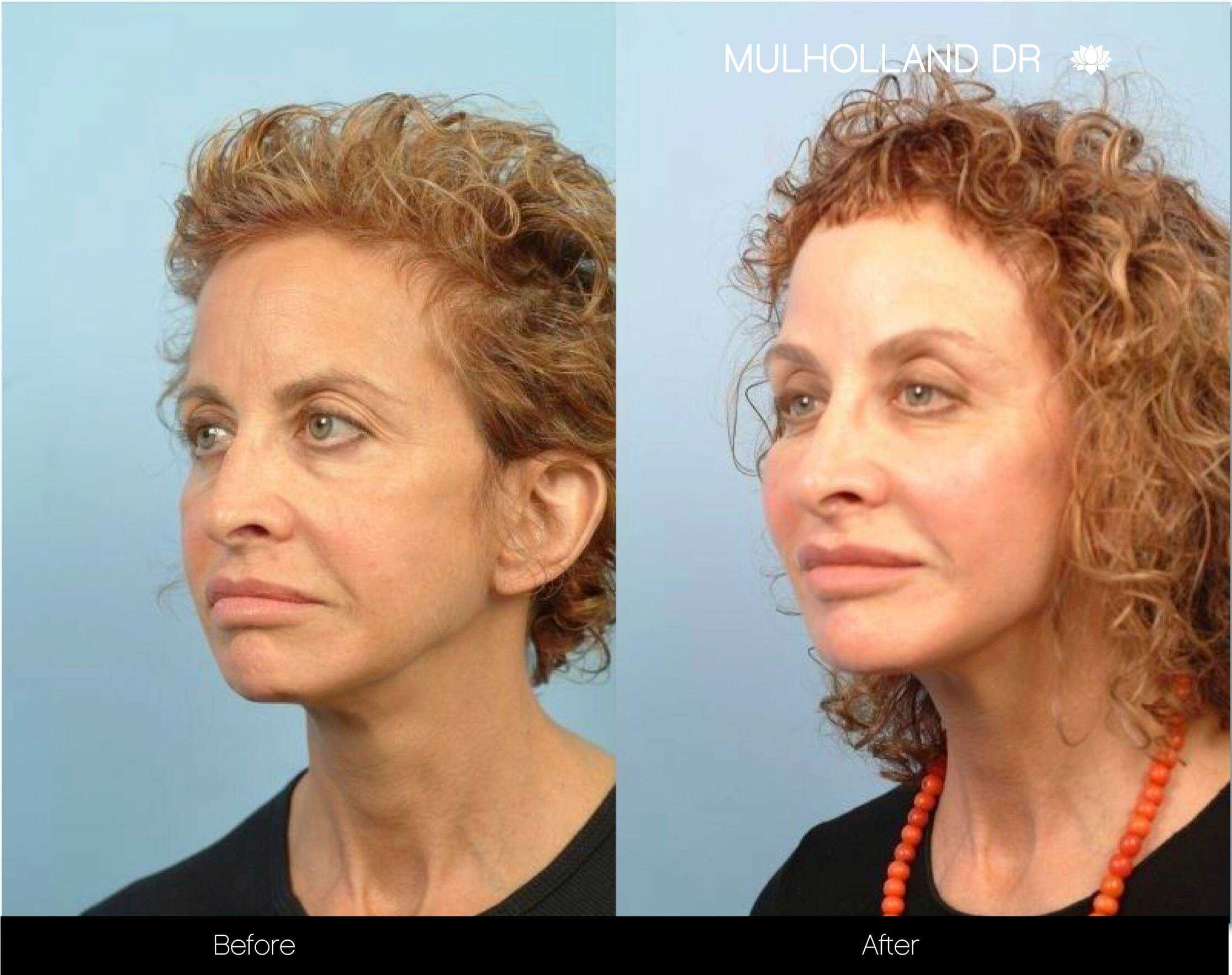 Dermal Fillers Before and After Gallery – Photo 14