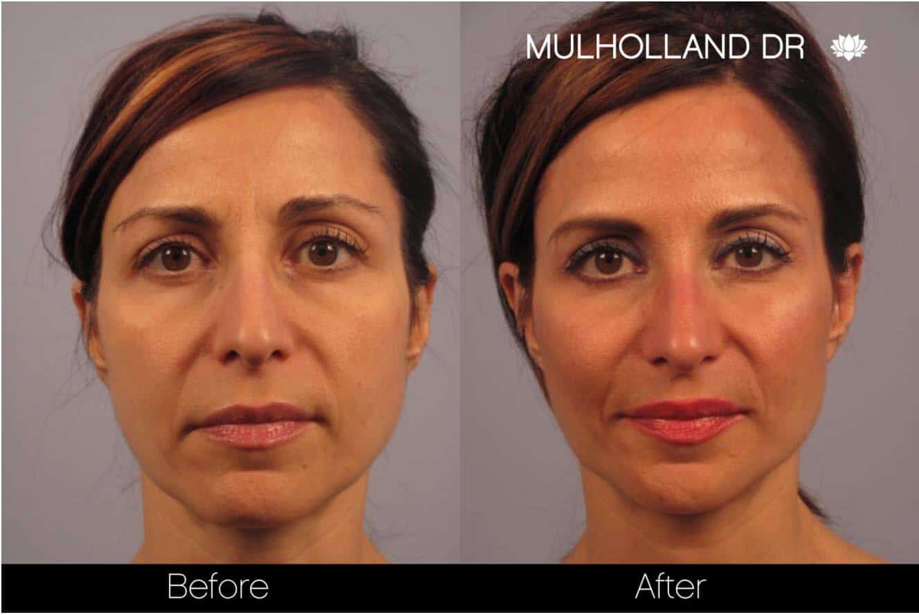 Dermal Fillers Before and After Gallery – Photo 13