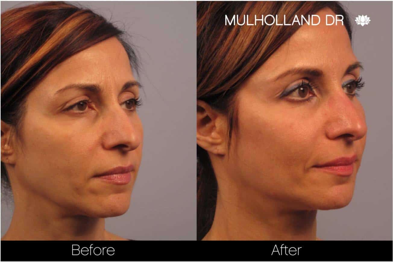 Dermal Fillers Before and After Gallery – Photo 12