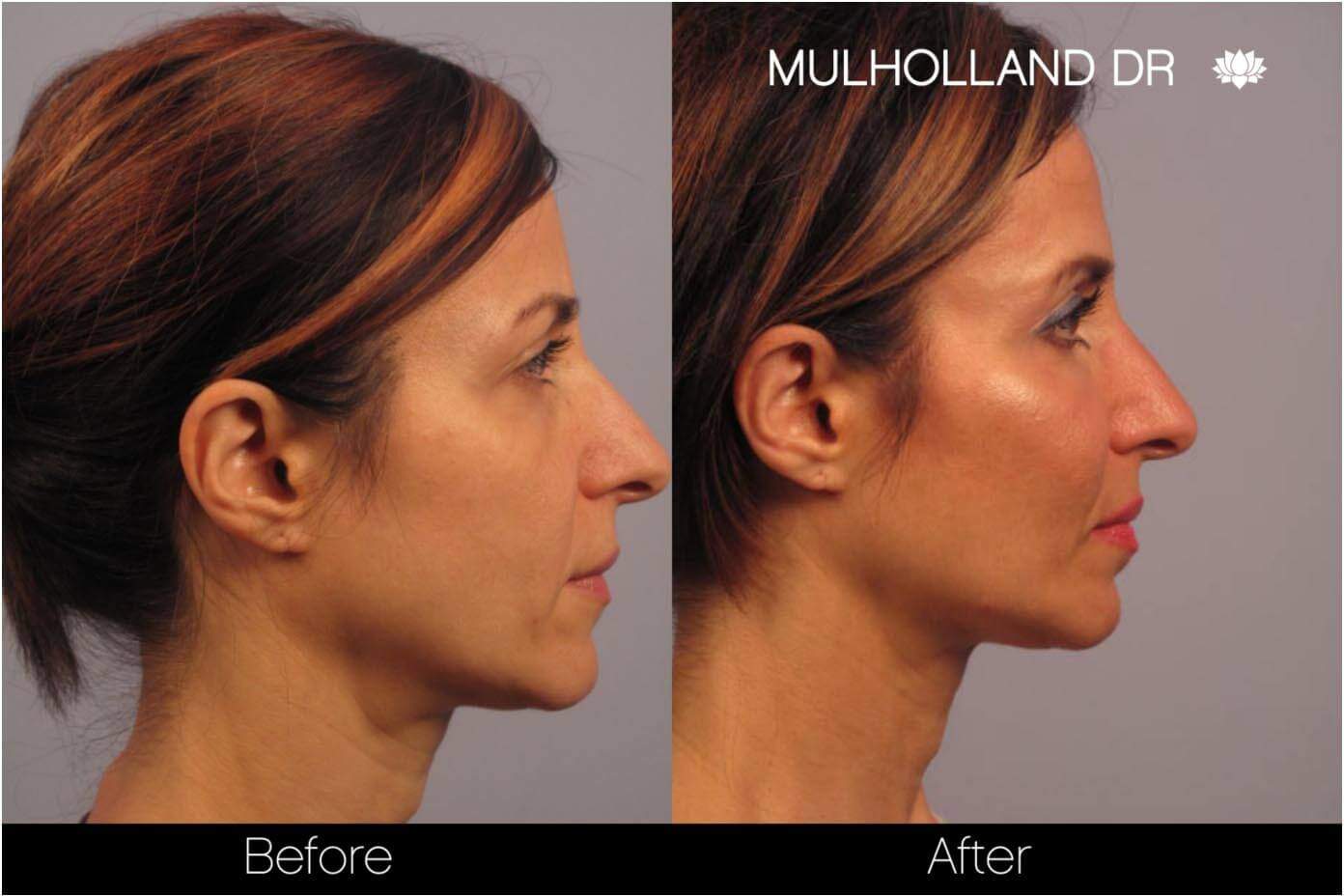 Dermal Fillers Before and After Gallery – Photo 11