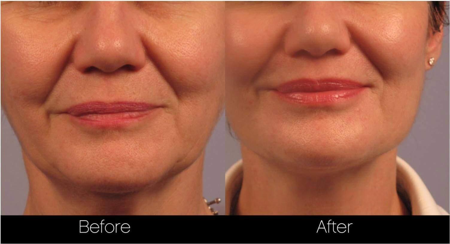 Dermal Fillers Before and After Gallery – Photo 10