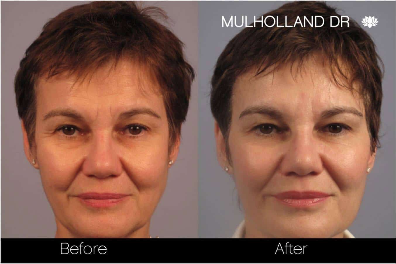 Dermal Fillers Before and After Gallery – Photo 9