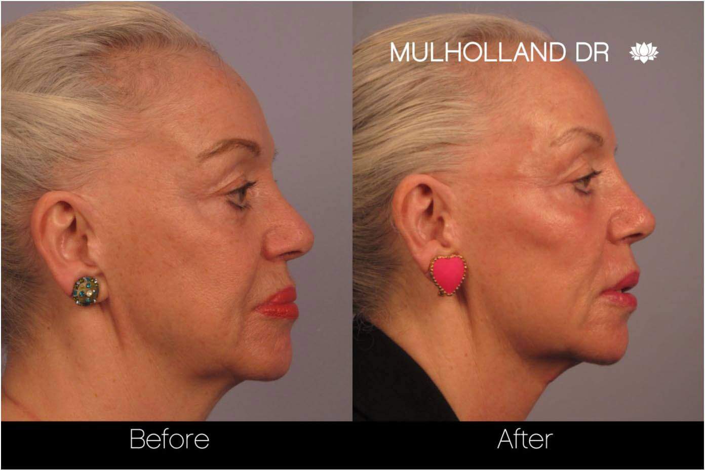 Dermal Fillers Before and After Gallery – Photo 8
