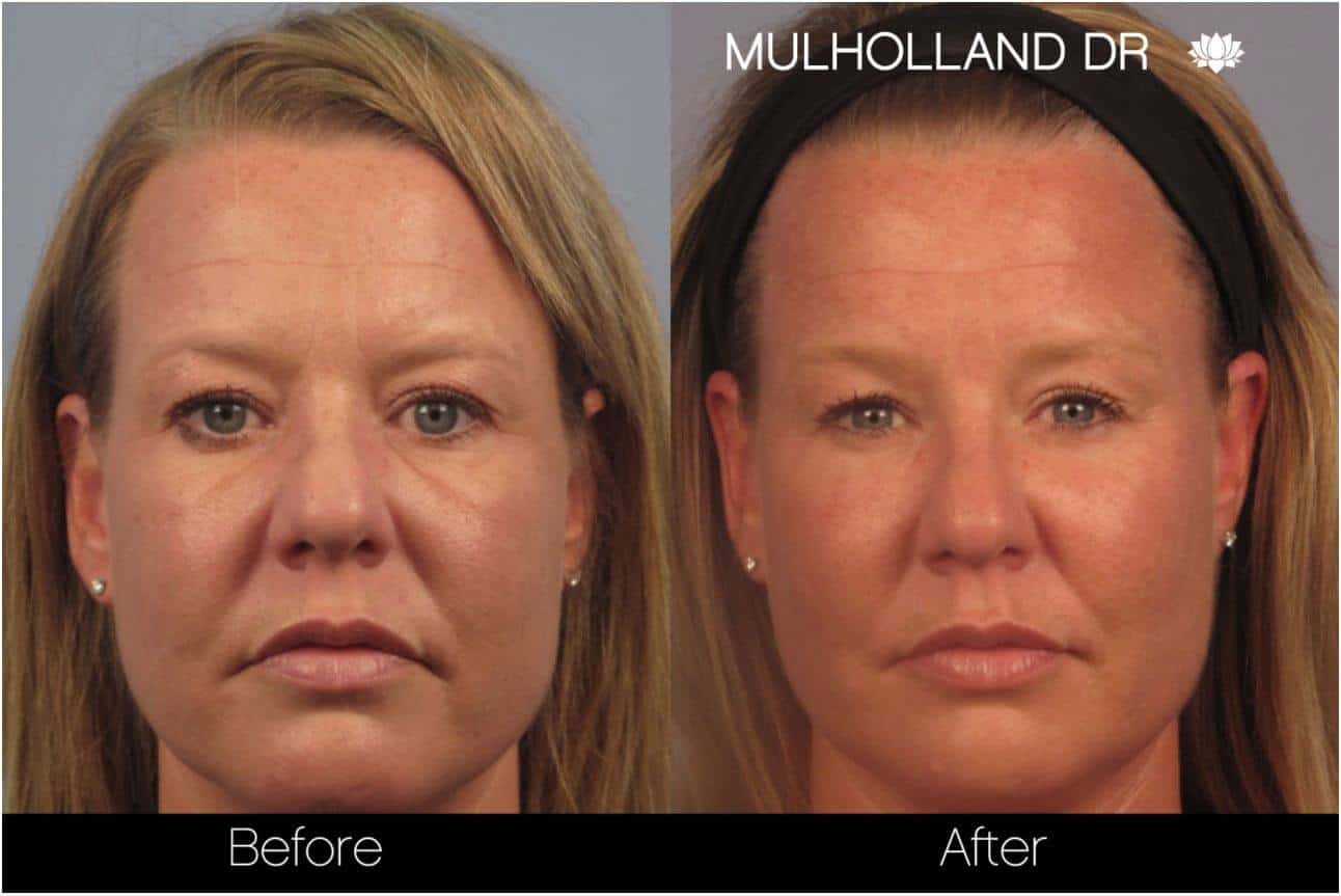 Dermal Fillers Before and After Gallery – Photo 7