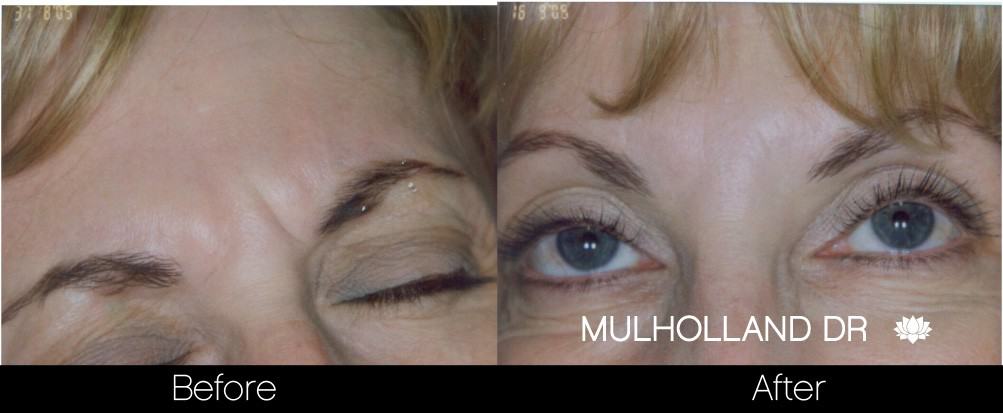 Botox Before and After Gallery - Photo 18