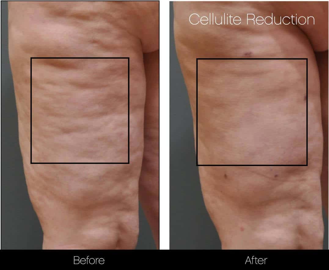 Cellulite Reduction Before and After Gallery – Photo 21