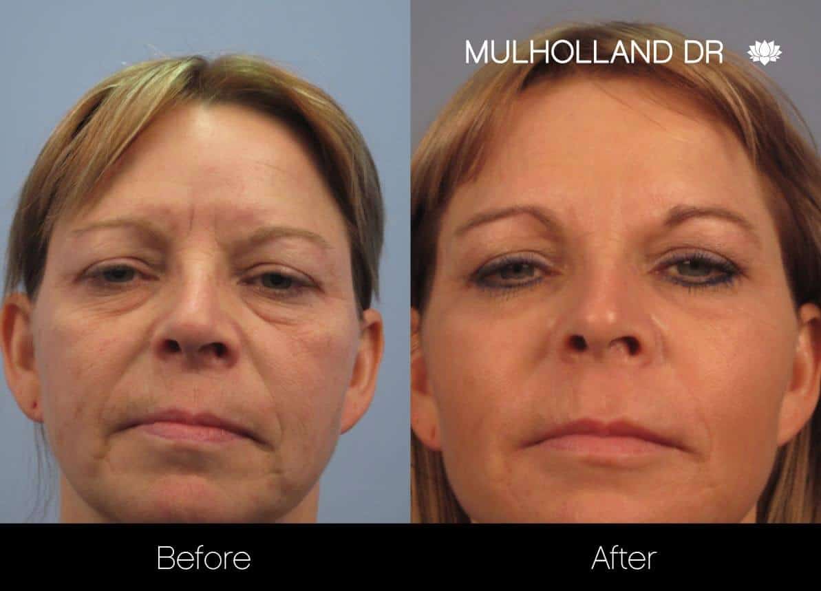Dermal Fillers Before and After Gallery – Photo 6