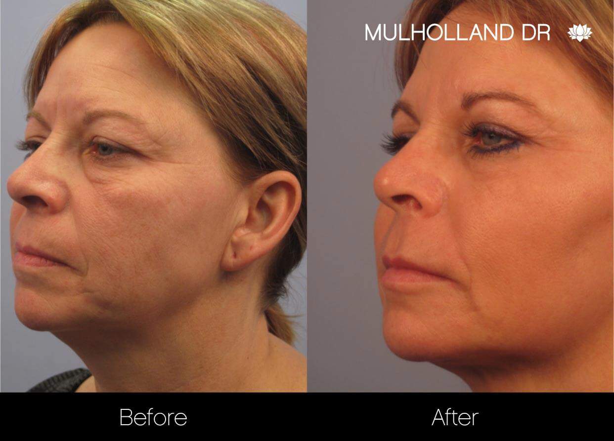 Dermal Fillers Before and After Gallery – Photo 5