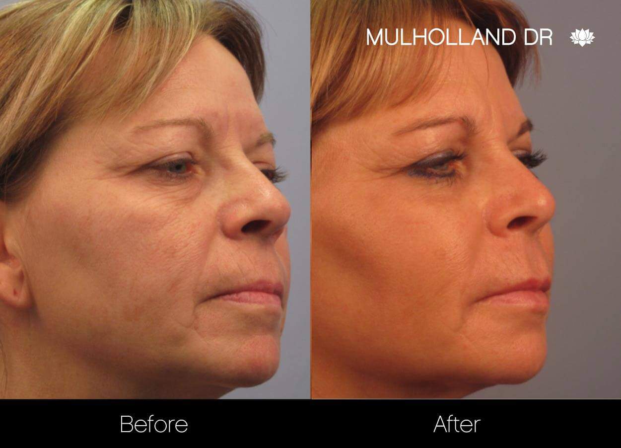 Dermal Fillers Before and After Gallery – Photo 4