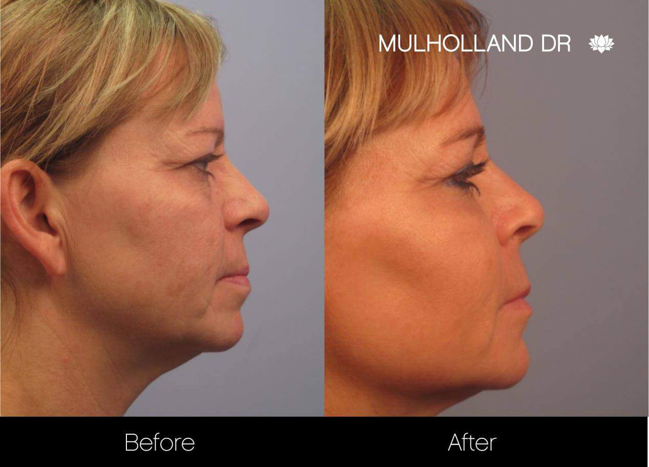 Dermal Fillers Before and After Gallery – Photo 3