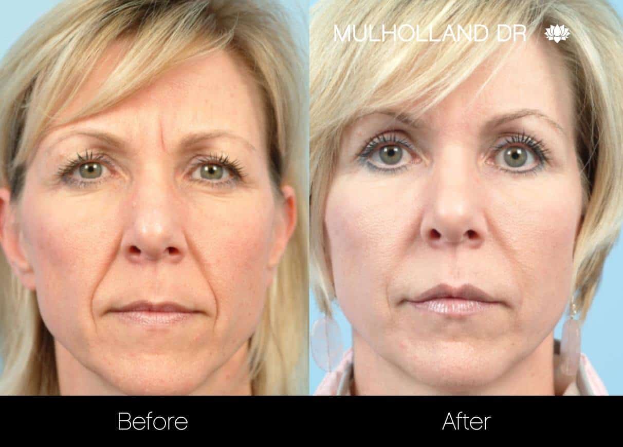Dermal Fillers Before and After Gallery – Photo 2