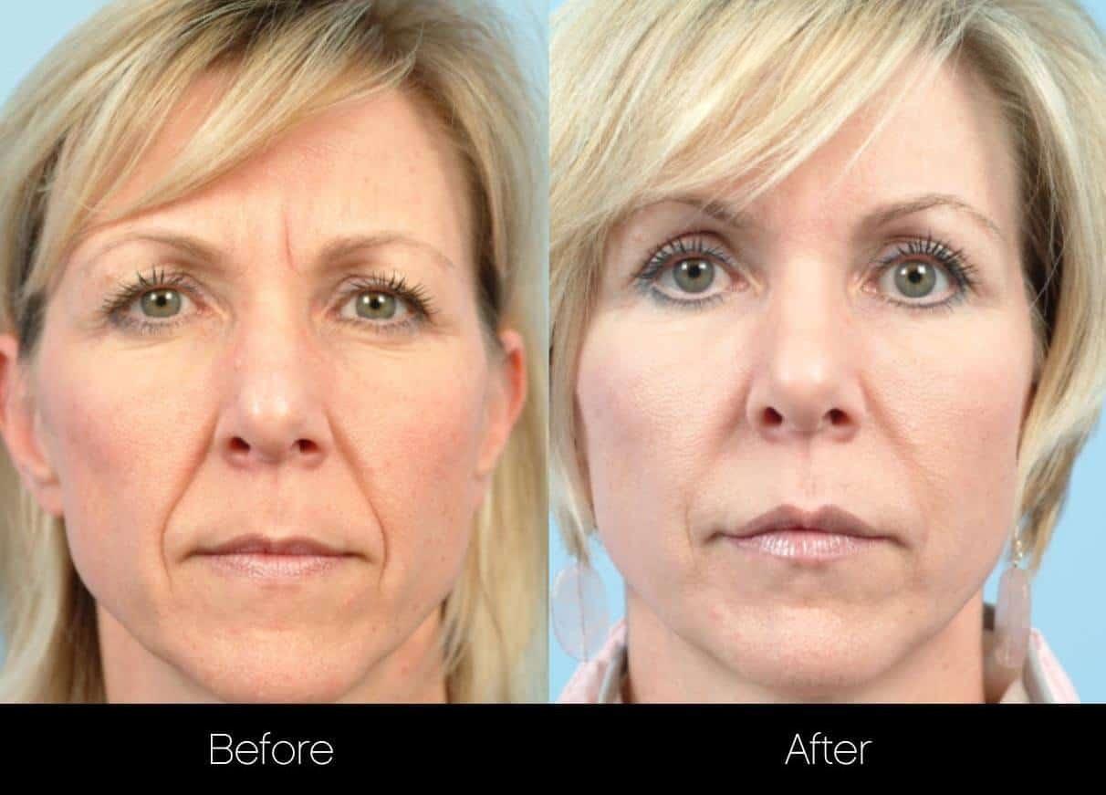 Dermal Fillers Before and After Gallery – Photo 2