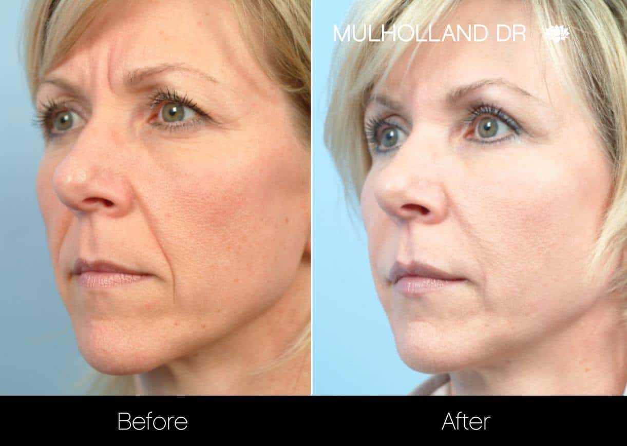 Dermal Fillers Before and After Gallery – Photo 1