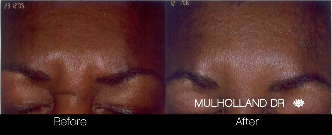 Botox Before and After Gallery - Photo 20