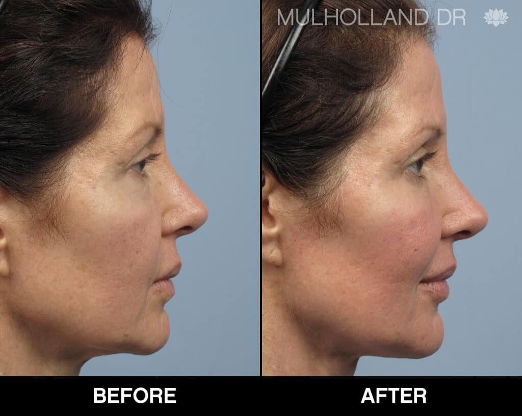 Dermal Fillers Before and After Gallery – Photo 130