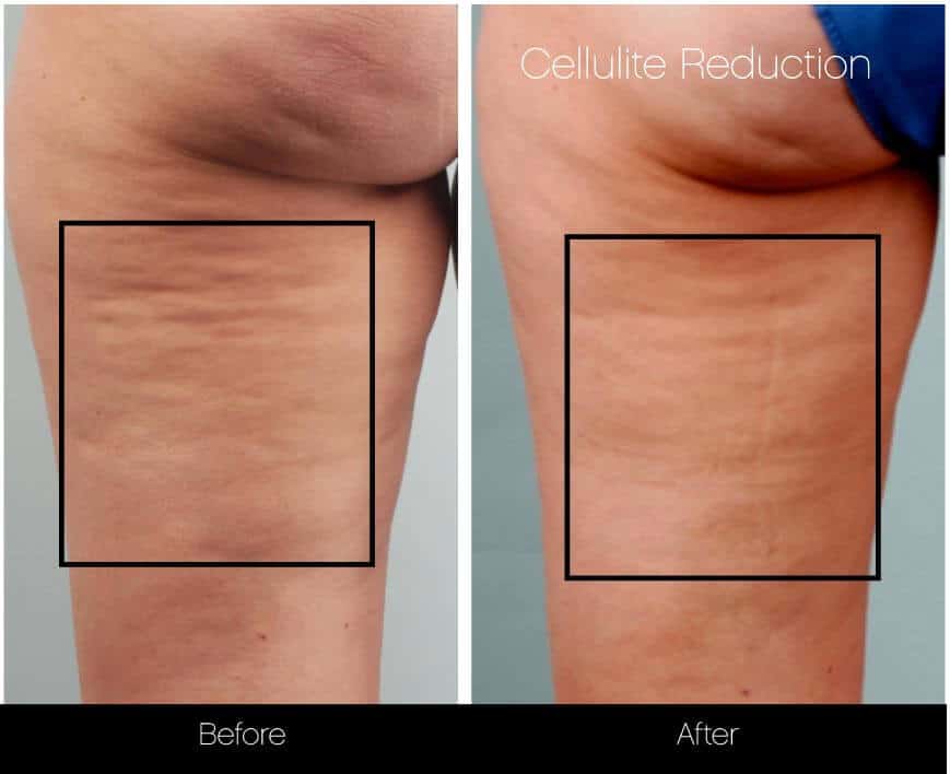Cellulite Reduction Before and After Gallery – Photo 20