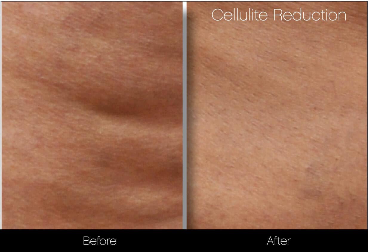 Cellulite Reduction Before and After Gallery – Photo 19