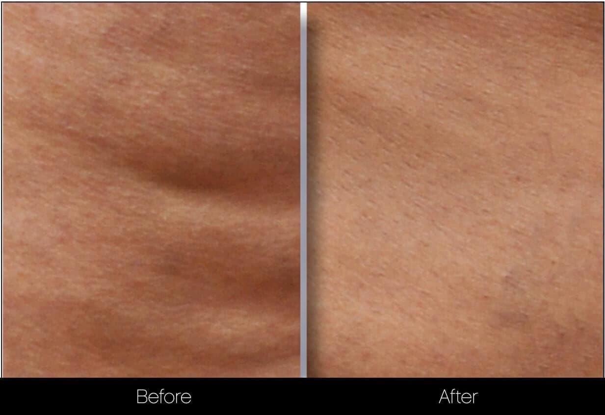 Cellulite Reduction Before and After Gallery – Photo 19