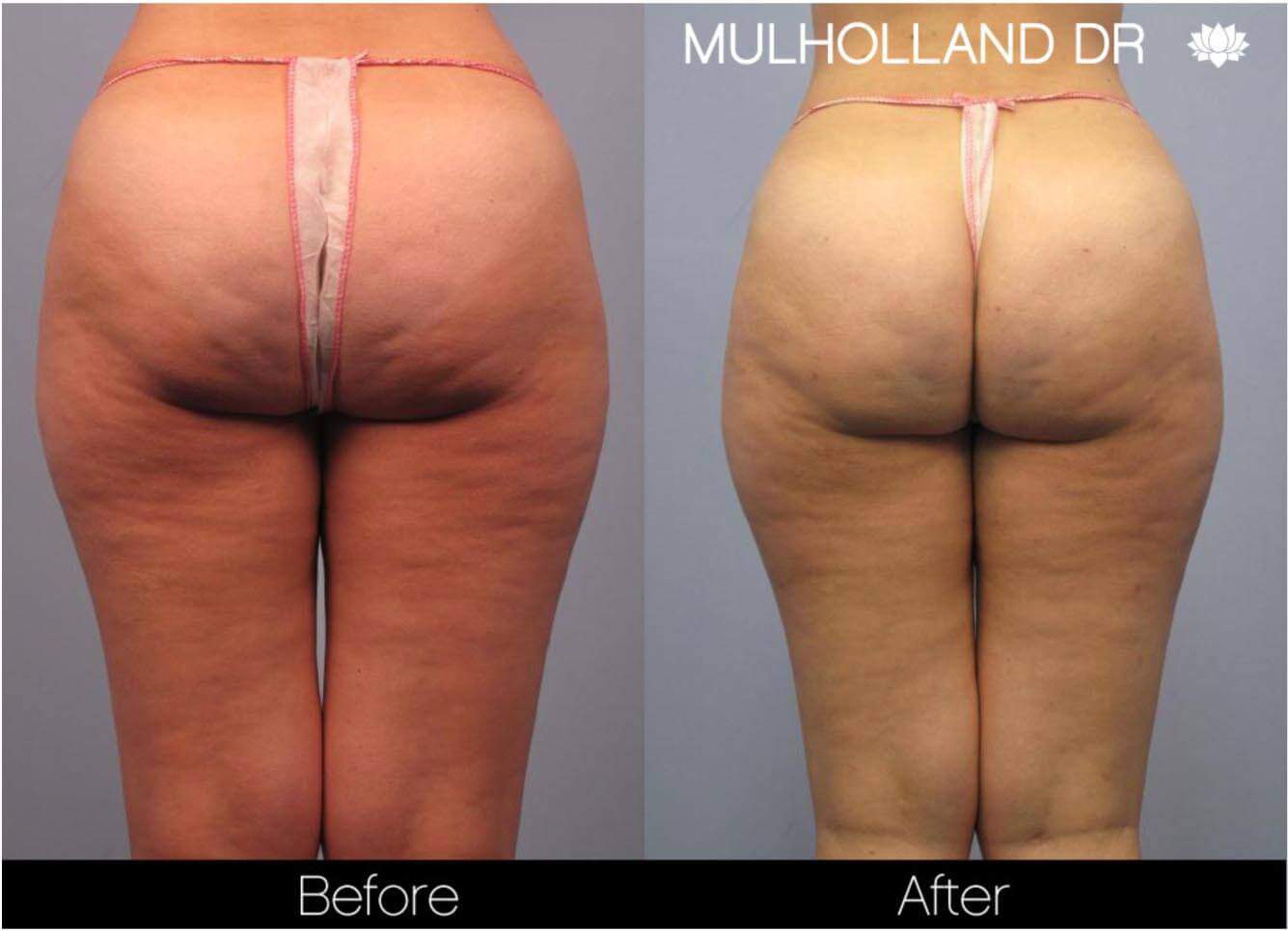 Cellulite Reduction Before and After Gallery – Photo 18