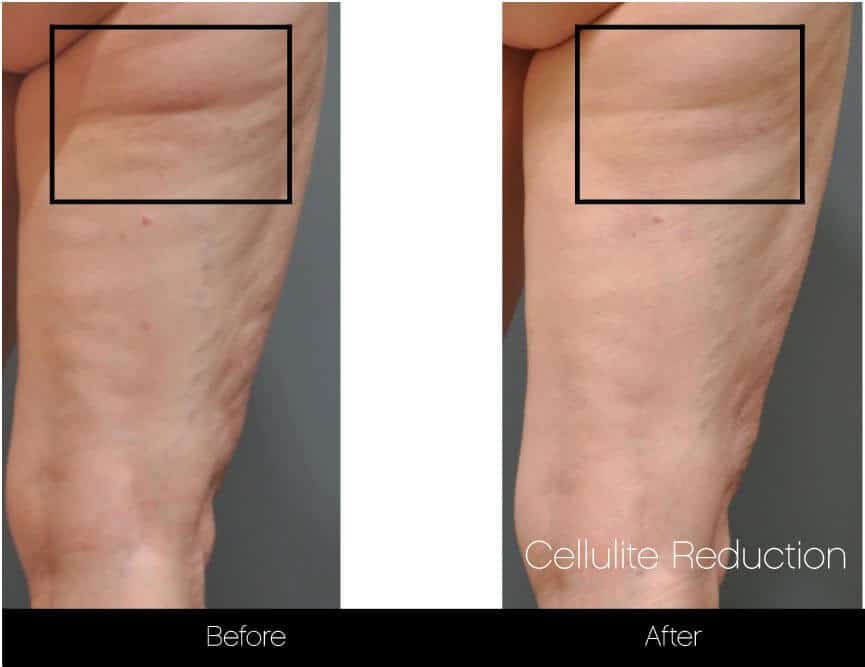 Cellulite Reduction Before and After Gallery – Photo 17