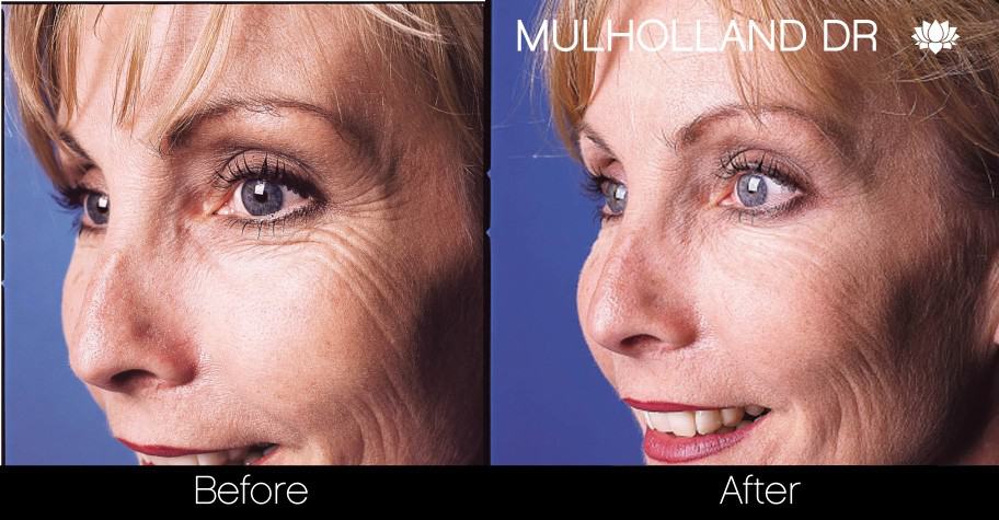Botox Before and After Gallery - Photo 16