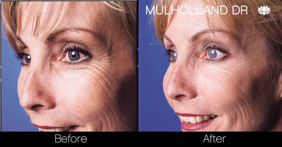 Best Botox Injection Clinic in Toronto | SpaMedica Best Botox Injection Clinic in Toronto | SpaMedica